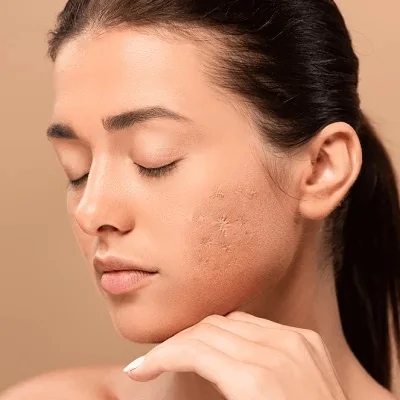 Scars Treatment
